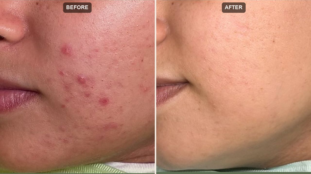 Acne & Scar Programs